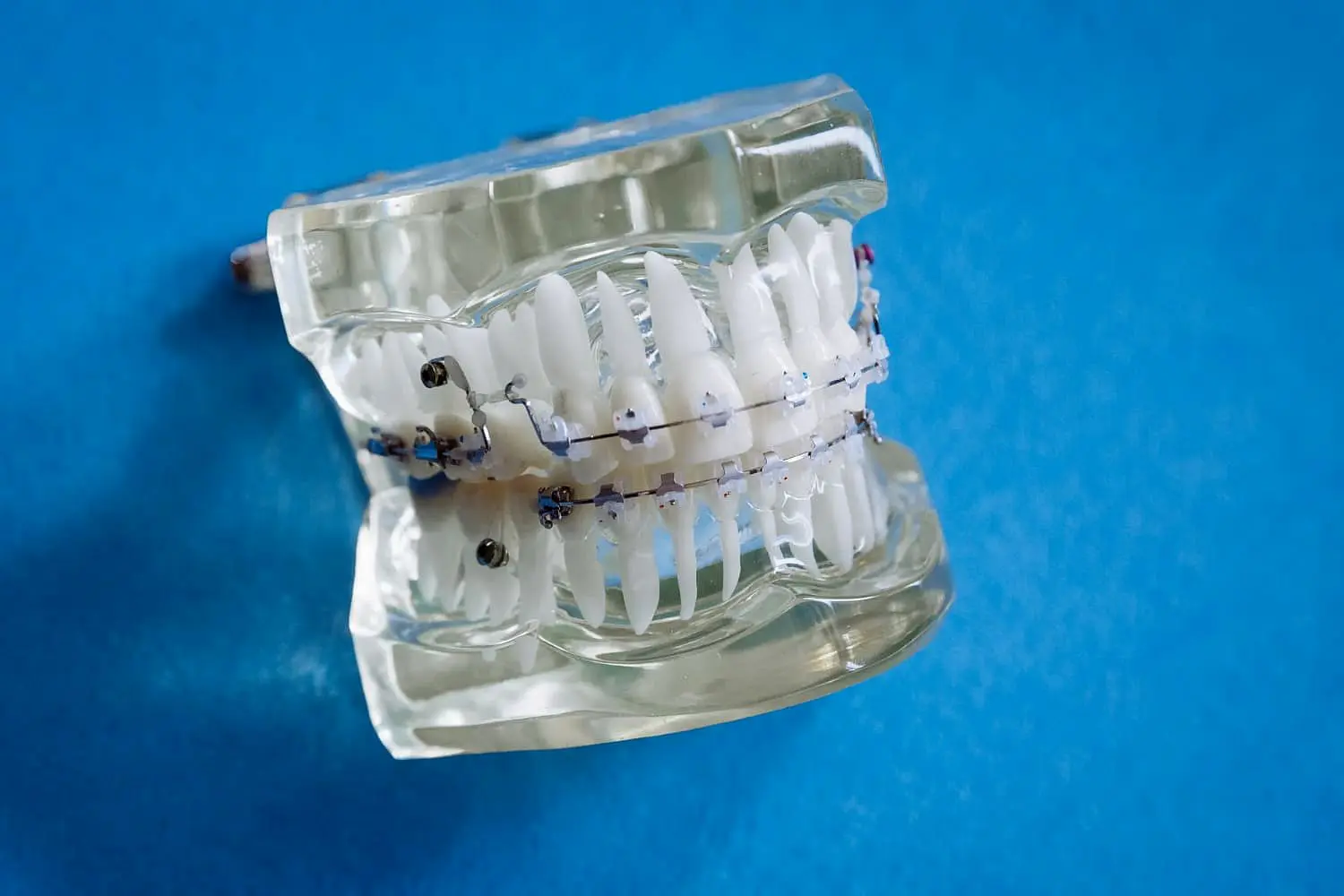 A dental model displays metal braces against a blue background, highlighting the look of traditional braces at Holt Orthodontics in Twinsburg, OH.