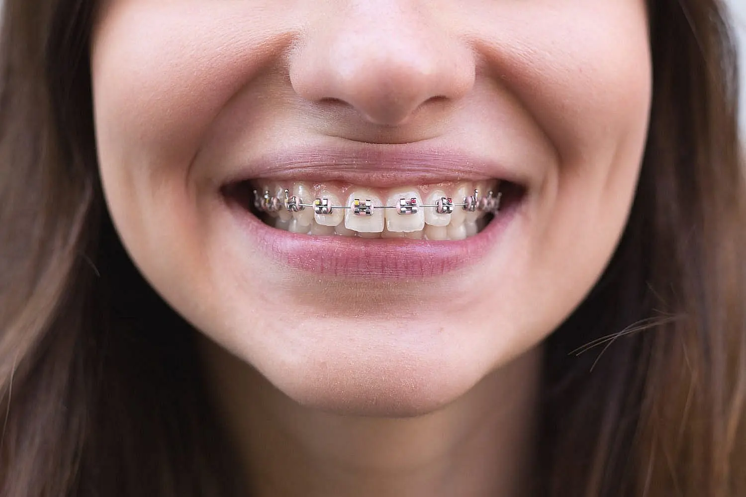 A person smiles, revealing metal braces used to correct an overbite at Holt Orthodontics in Twinsburg, OH.