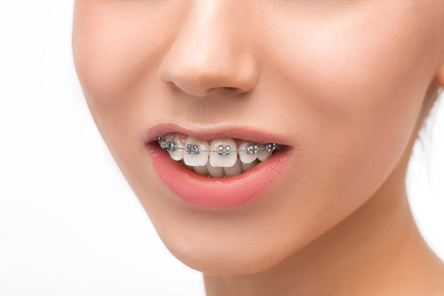 A close-up shows teeth with braces and an overbite, set against a white background, as featured by Holt Orthodontics in Twinsburg, OH.