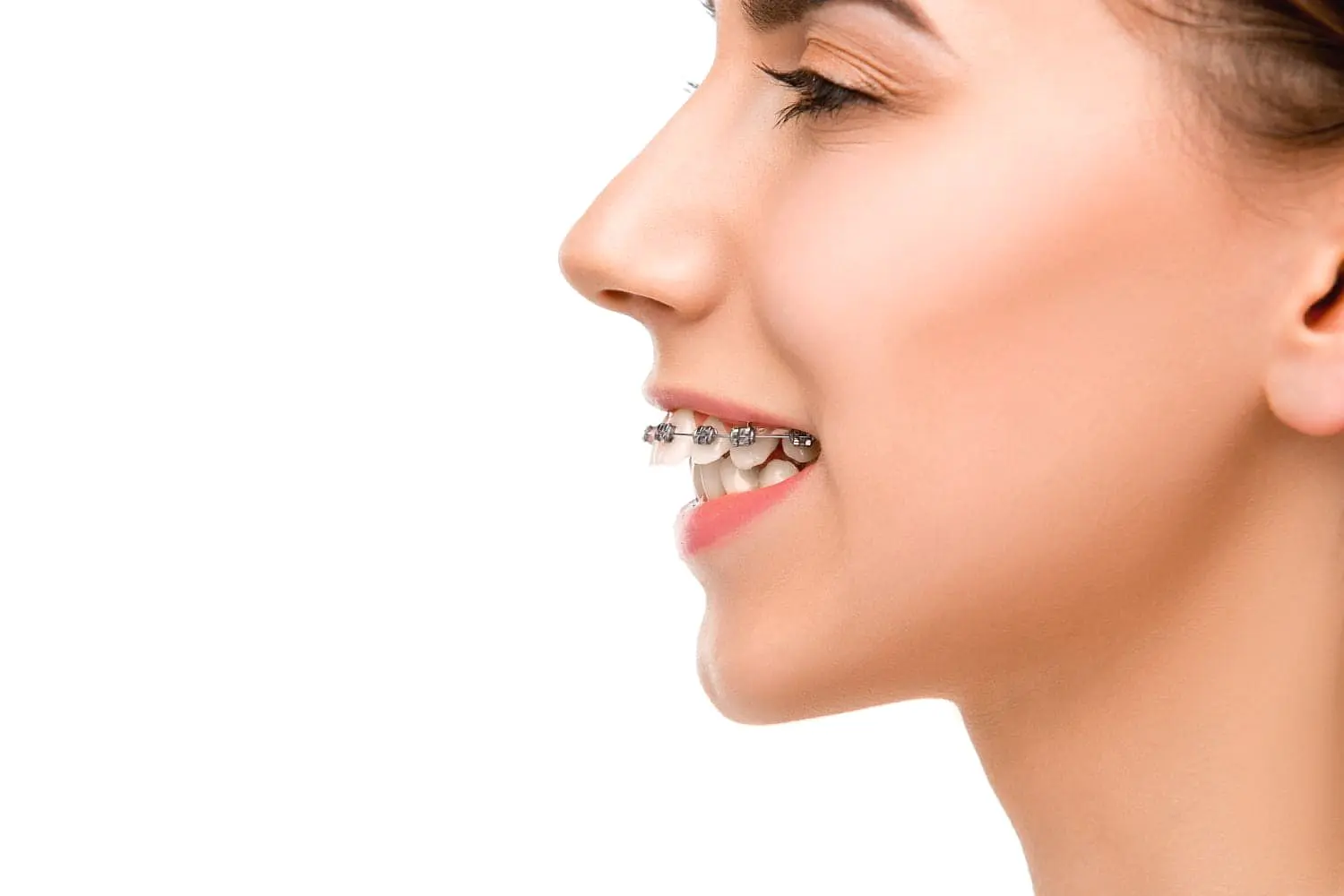 A woman smiles in side profile, displaying metal braces correcting her overbite at Holt Orthodontics in Twinsburg, OH.