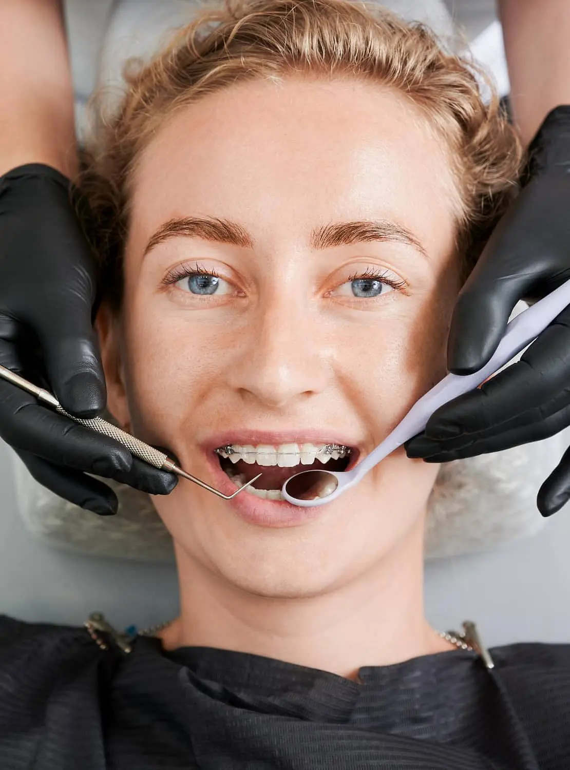 At Holt Orthodontics in Twinsburg, OH, a patient with clear ceramic braces receives a dental check-up as gloved hands hold instruments near their mouth.