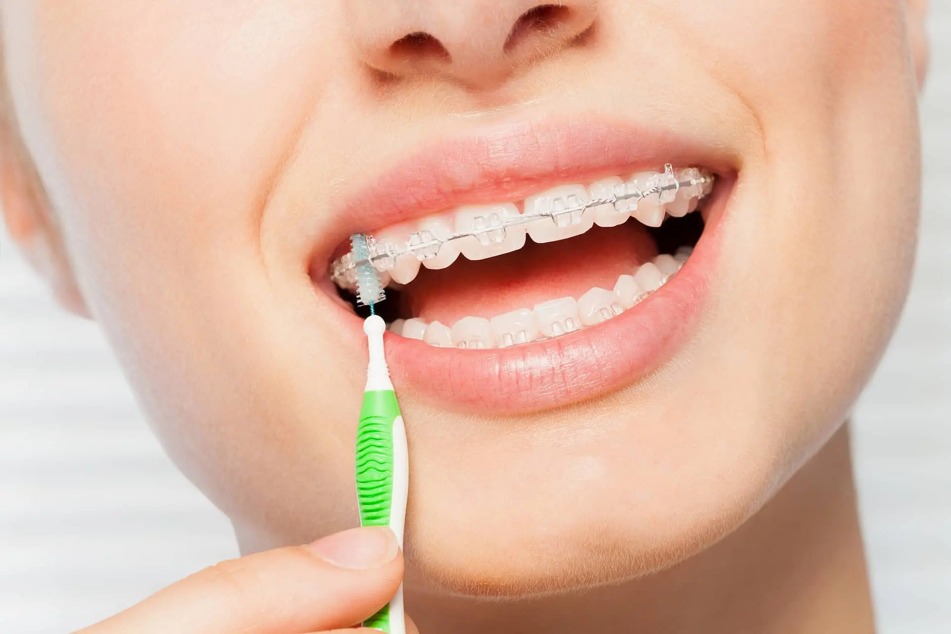 A close-up at Holt Orthodontics in Twinsburg, OH shows a person cleaning clear braces with an interdental brush, focusing on the teeth, lips, and part of the mouth.