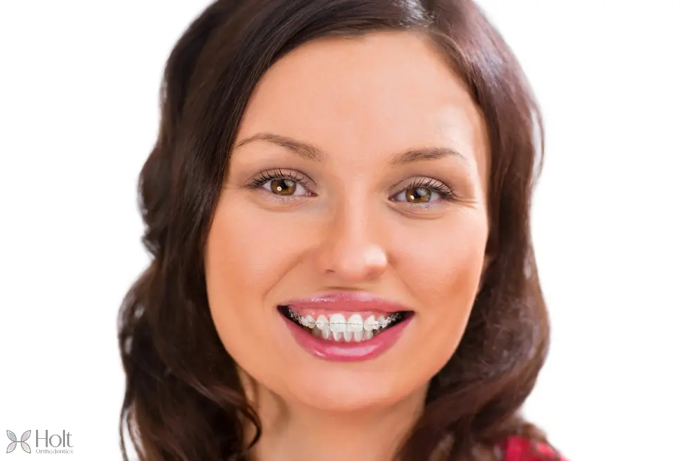 woman wearing orthodontic ceramic clear braces - Overbite vs Underbite in Twinsburg, OH
