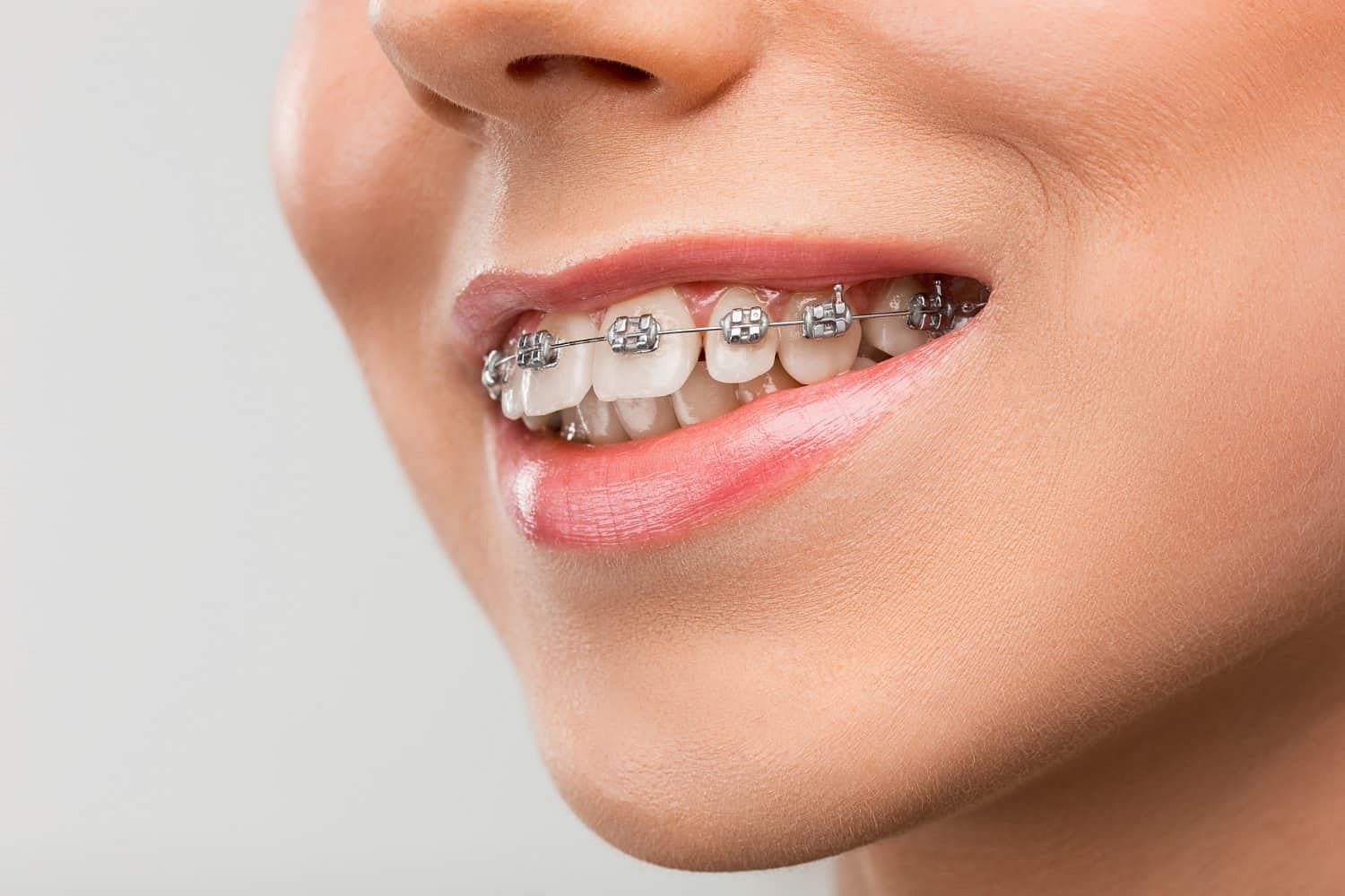 A close-up shows metal braces correcting an overbite at Holt Orthodontics in Twinsburg, OH, with a smiling mouth against a neutral background.