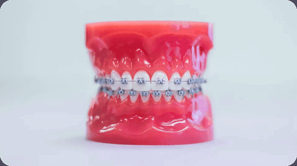 At Holt Orthodontics in Twinsburg, OH, a dental model with both upper and lower teeth fitted with metal braces is displayed against a plain background, showcasing the structure and look of traditional metal braces.