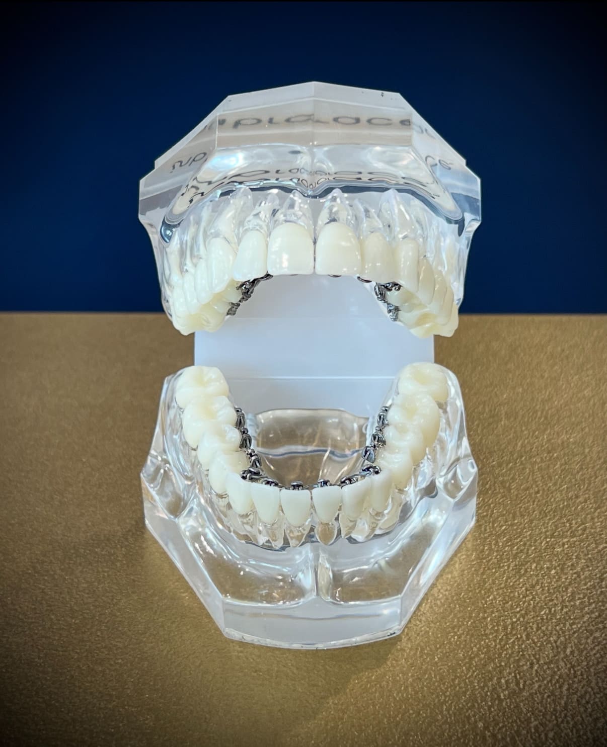 A dental model with Lingual braces on upper and lower teeth is shown on a clear stand for Holt Orthodontics in Twinsburg, OH.