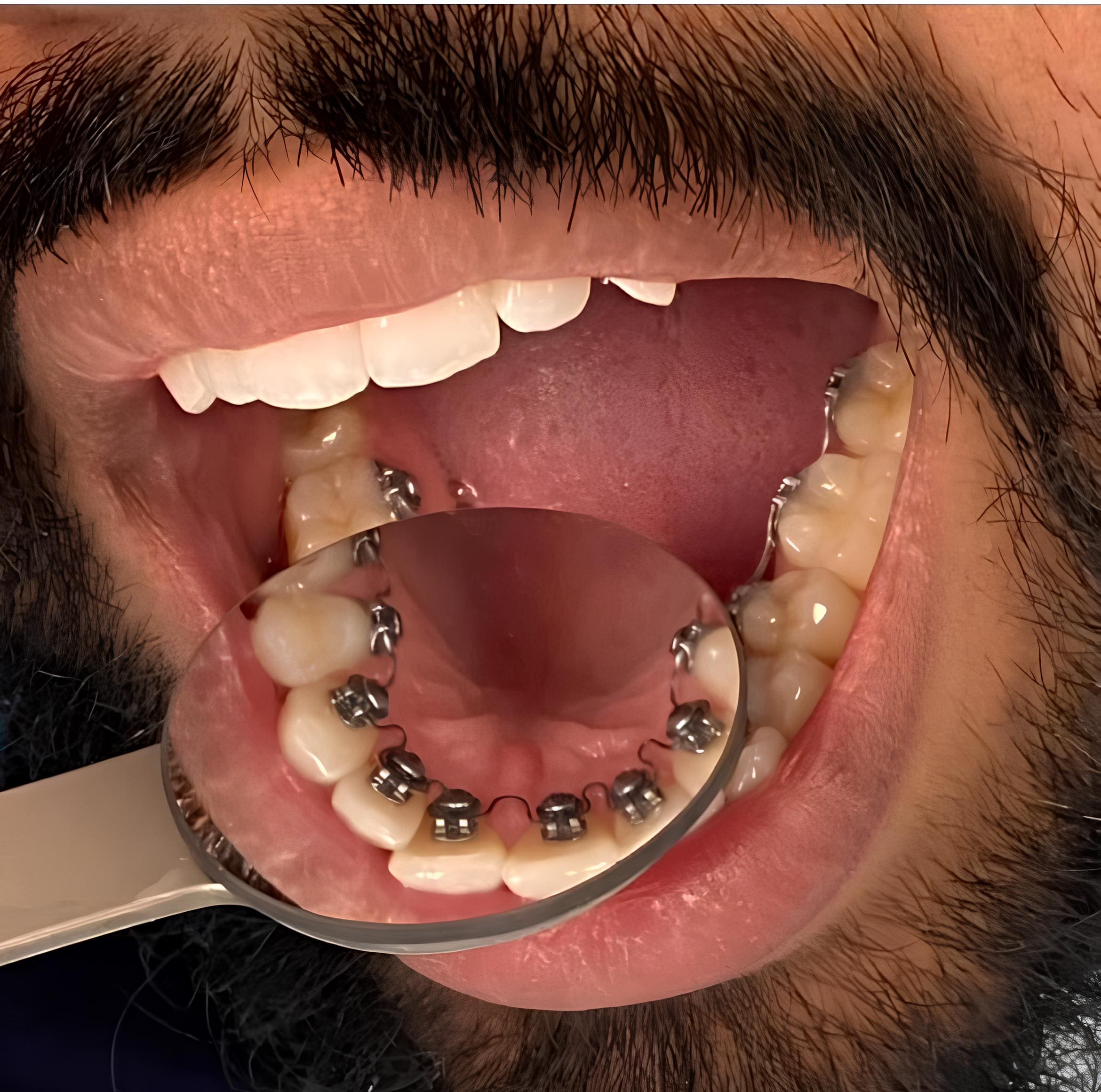 A close-up of an open mouth with a dental mirror shows lingual braces on lower teeth at Holt Orthodontics in Twinsburg, OH.