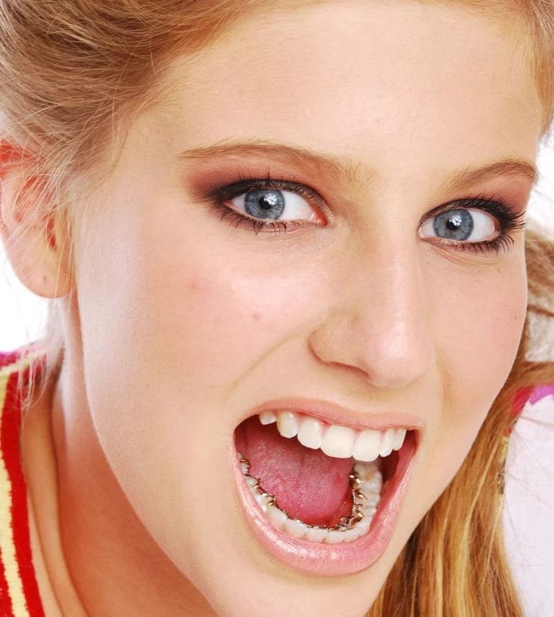 A young woman with blue eyes and lingual braces smiles, promoting Holt Orthodontics in Twinsburg, OH.